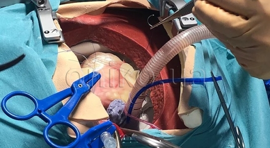 NOVINKA // Vysoce realistický trenažér kardiohrudní chirurgie