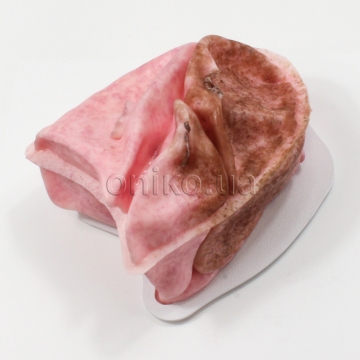 VATS Replacement Lung (Collapse)