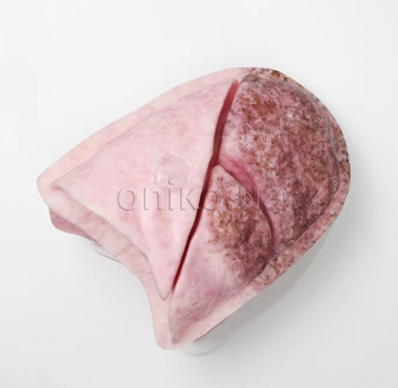 Wedge Replacement Lung (Full)