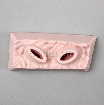 EMS Gastric Ulcer Superior