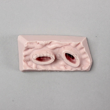 EMS Gastric Ulcer Inferior