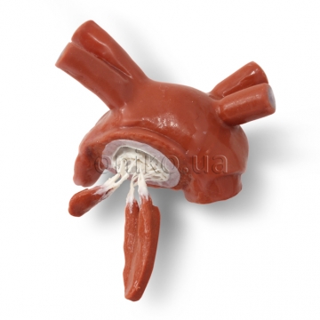 Prolaps mitrální chlopně s chordami a papilárními svaly