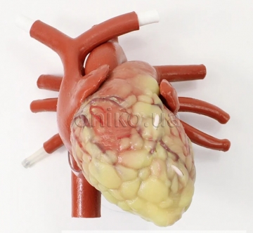 Zvětšené bijící srdce dospělého pacienta pro minimálně invazivní kardiochirurgii mitrální chlopně a aortokoronární bypass s pomocnými komponenty