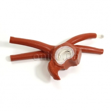 Zvětšená levá síň dospělého pacienta s normální mitrální chlopní pro minimálně invazivní kardiochirurgii