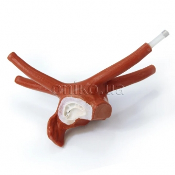 Zvětšená levá síň dospělého pacienta s prolapsem mitrální chlopně pro minimálně invazivní kardiochirurgii