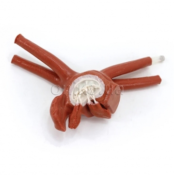 Zvětšená levá síň dospělého pacienta s prolapsem mitrální chlopně, chordami a papilárními svaly pro minimálně invazivní kardiochirurgii