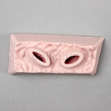 Tkáň se žaludečním vředem (horní)