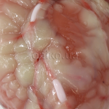 Místa pro aortokoronární bypass