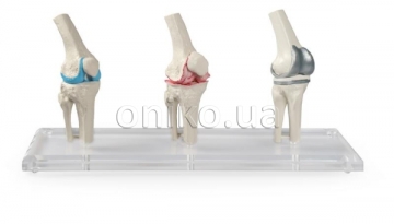 Модель коленного имплантата