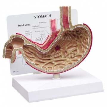 Stomach with ulcers
