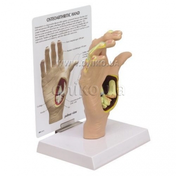 Osteoarthritis (OA) hand