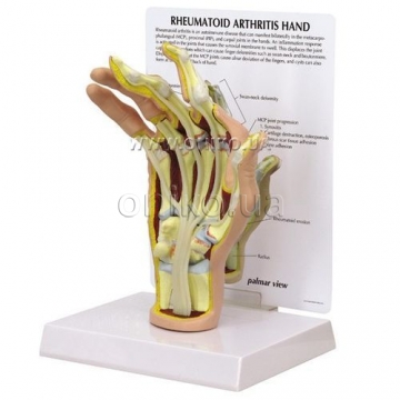 Rheumatoid arthritis (RA) hand