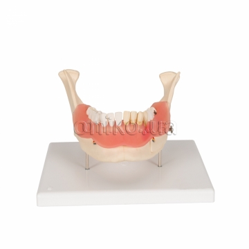 Модель хвороби зубів