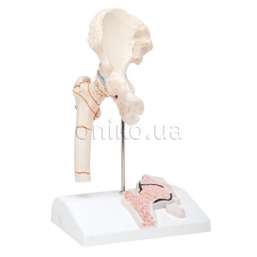 Модель перелому стегнової кістки і остеоартрит тазостегнового суглоба