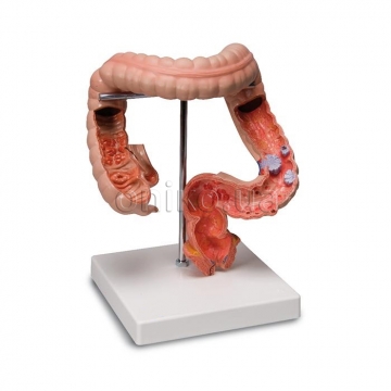 Модель заболевания кишечника