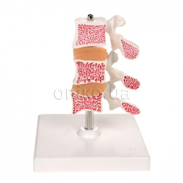 Deluxe Human Osteoporosis Model (3 Vertebrae with Discs ), Removable on Stand