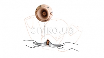 https://oniko.ua/images/services/services/80180-prompt-flex-cervical-cerclage-module-light-01-small.jpg