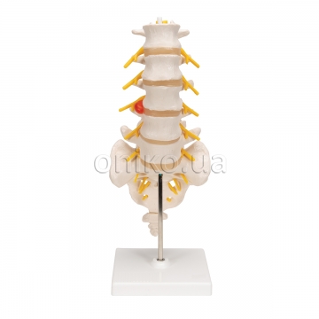 Human Lumbar Spinal Column with Prolapsed Intervertebral Disc